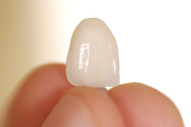 Ein graziles Non-Prep Veneer aus Keramik eignet sich hervorragend Zähne zu verbessern und verschönern wenn diese zum Beispiel zu klein sind